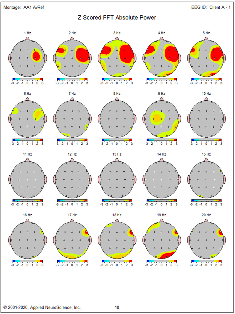 Z-scored FFT absolute power topographic maps showing bilateral excess activity from 2-6 Hz